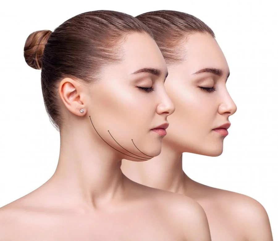 Kybella (Liquid Lipo) in Addison, TX