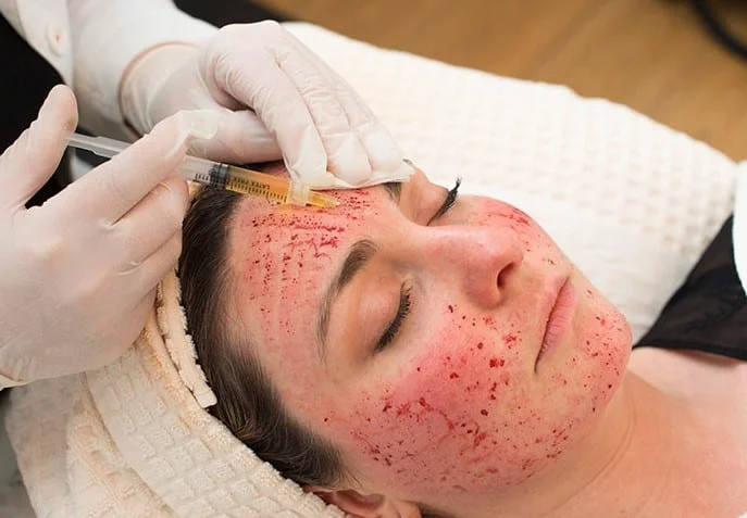 Vampire Facial ® in Addison, TX