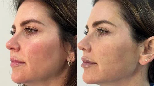 Jawline-Contouring-before-and-after-star-rejuvenation-Addison-TX