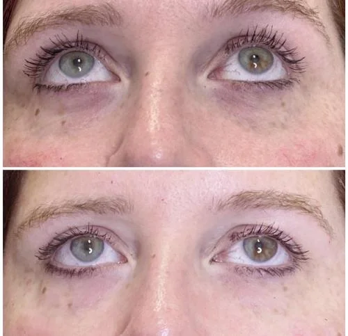 Tear-Filler-before-and-after-star-rejuvenation-Addison-TX