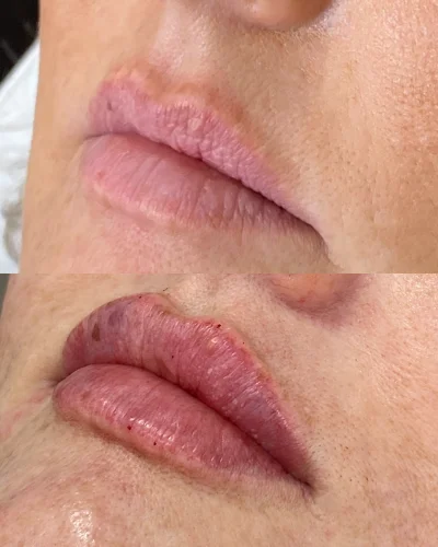 dermal-lip-after-and-before-star-rejuvenation-Addison-TX