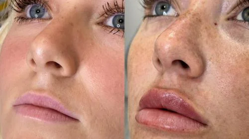 dermal-lip-after-before-star-rejuvenation-Addison-TX