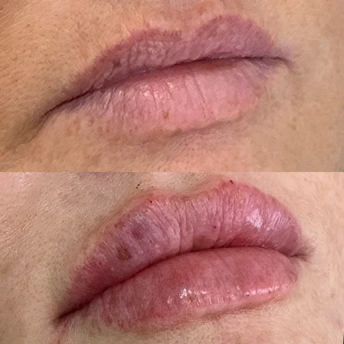 dermal-lip-after-star-rejuvenation-Addison-TX