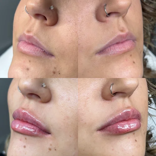 dermal-lip-before-after-star-rejuvenation-Addison-TX