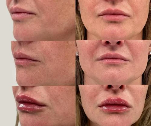 lip-after-and-before-star-rejuvenation-Addison-TX