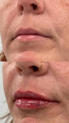 lip-after-before-star-rejuvenation-Addison-TX