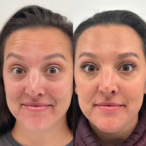 neuro-beforeandafter-star-rejuvenation-Addison-TX