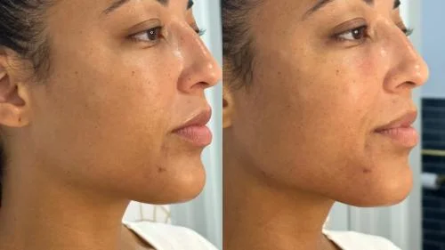 Jawline-Contouring-after-star-rejuvenation-Addison-TX