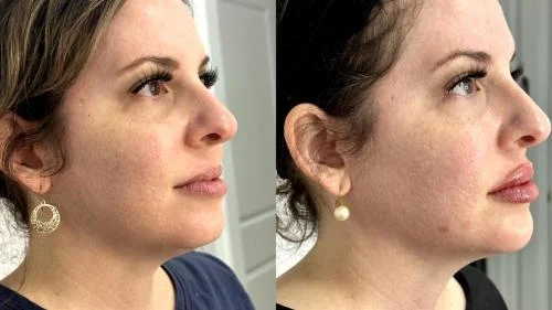 Jawline-Contouring-banda-star-rejuvenation-Addison-TX