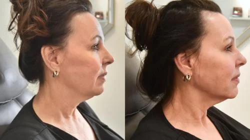 Jawline-Contouring-before-star-rejuvenation-Addison-TX