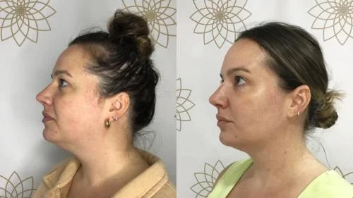 Jawline-Contouring-star-rejuvenation-Addison-TX