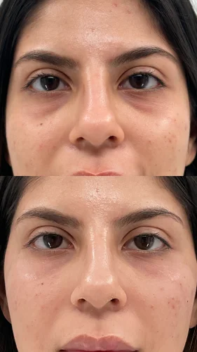 Tear-Trough-Filler-after-star-rejuvenation-Addison-TX