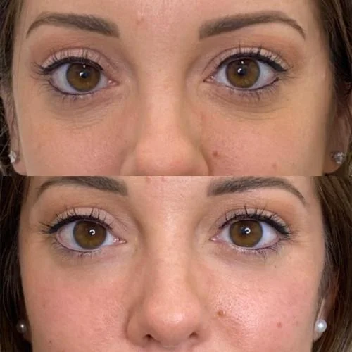 Tear-Trough-Filler-before-after-star-rejuvenation-Addison-TX