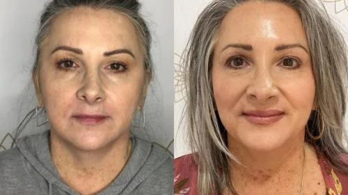 Tear-Trough-Filler-before-and-after-star-rejuvenation-Addison-TX