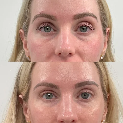 Tear-Trough-Filler-before-star-rejuvenation-Addison-TX