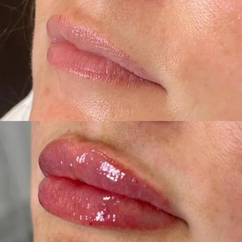 dermal-lip-before-and-after-star-rejuvenation-Addison-TX