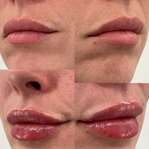 dermal-lip-before-star-rejuvenation-Addison-TX