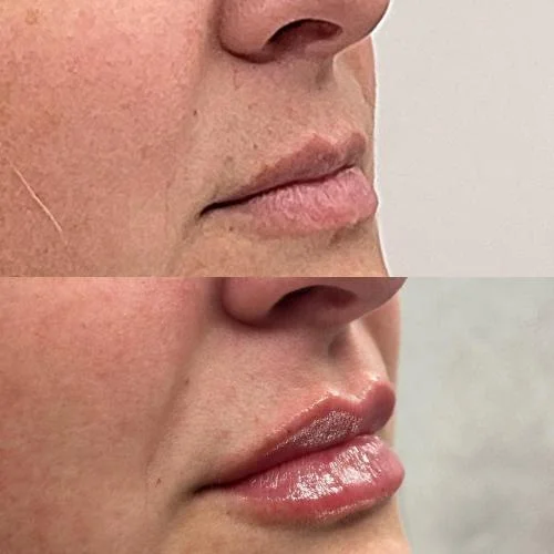 lip-after-star-rejuvenation-Addison-TX